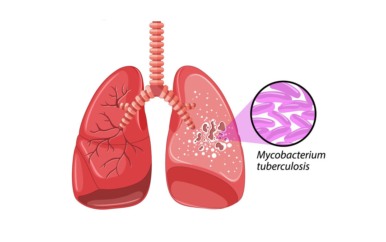 Tuberculose – Saber para agir