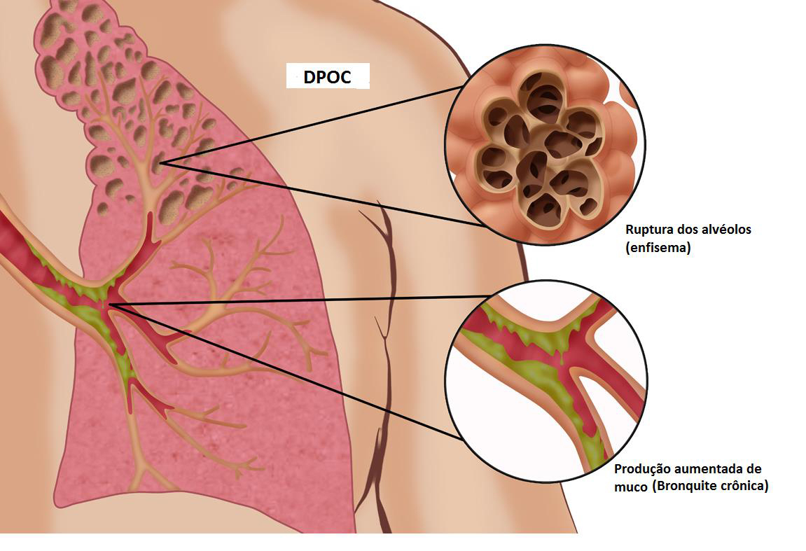 Doença pulmonar obstrutiva crónica